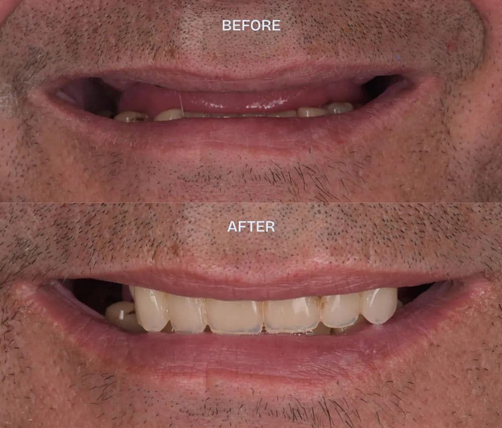 Before and after — Implant-supported teeth
