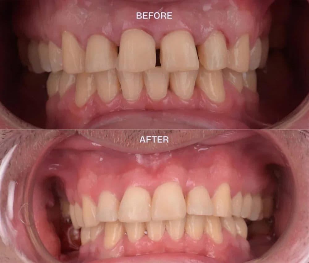 Vorher und nachher — Smile Makeover