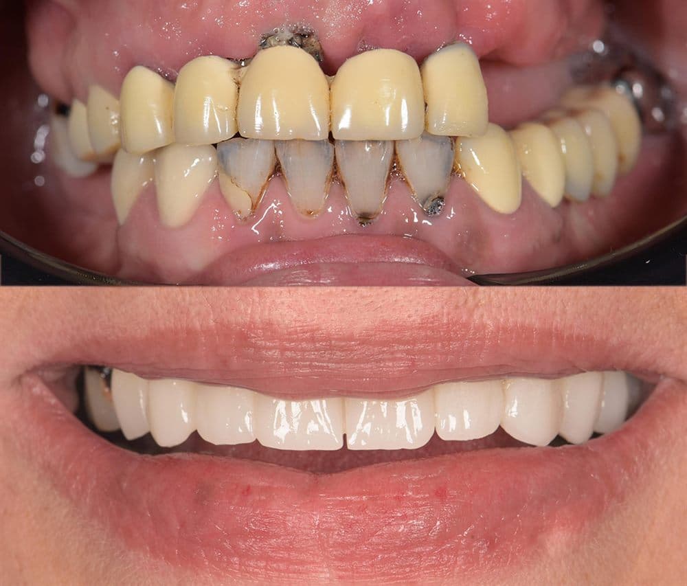 Vorher und nachher — Mehrere Implantate