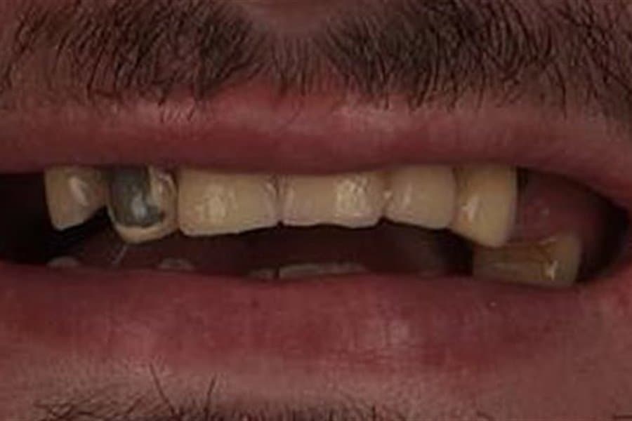 A patient's smile before treatment — damaged and missing teeth